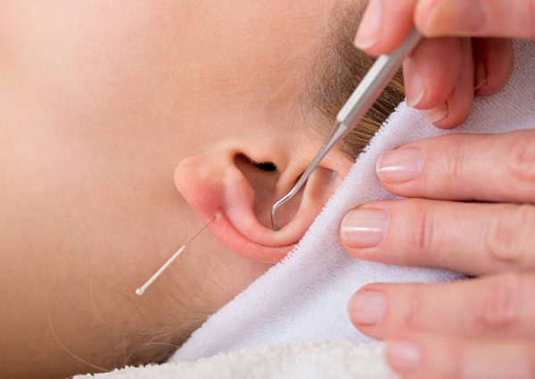Homeopath treating woman with acupuncture. Close-up of a chiropractor treating woman with ear acupuncture techniques  also known as auriculotherapy